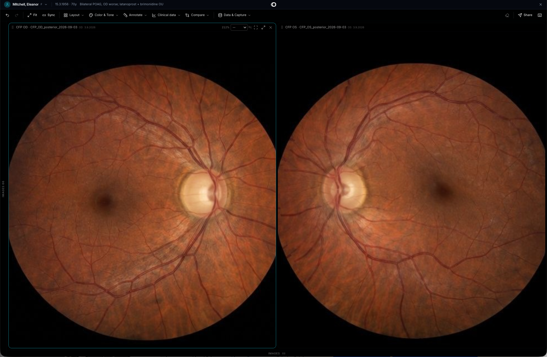 Two eye photos of the same patient side by side, with earlier photos to compare