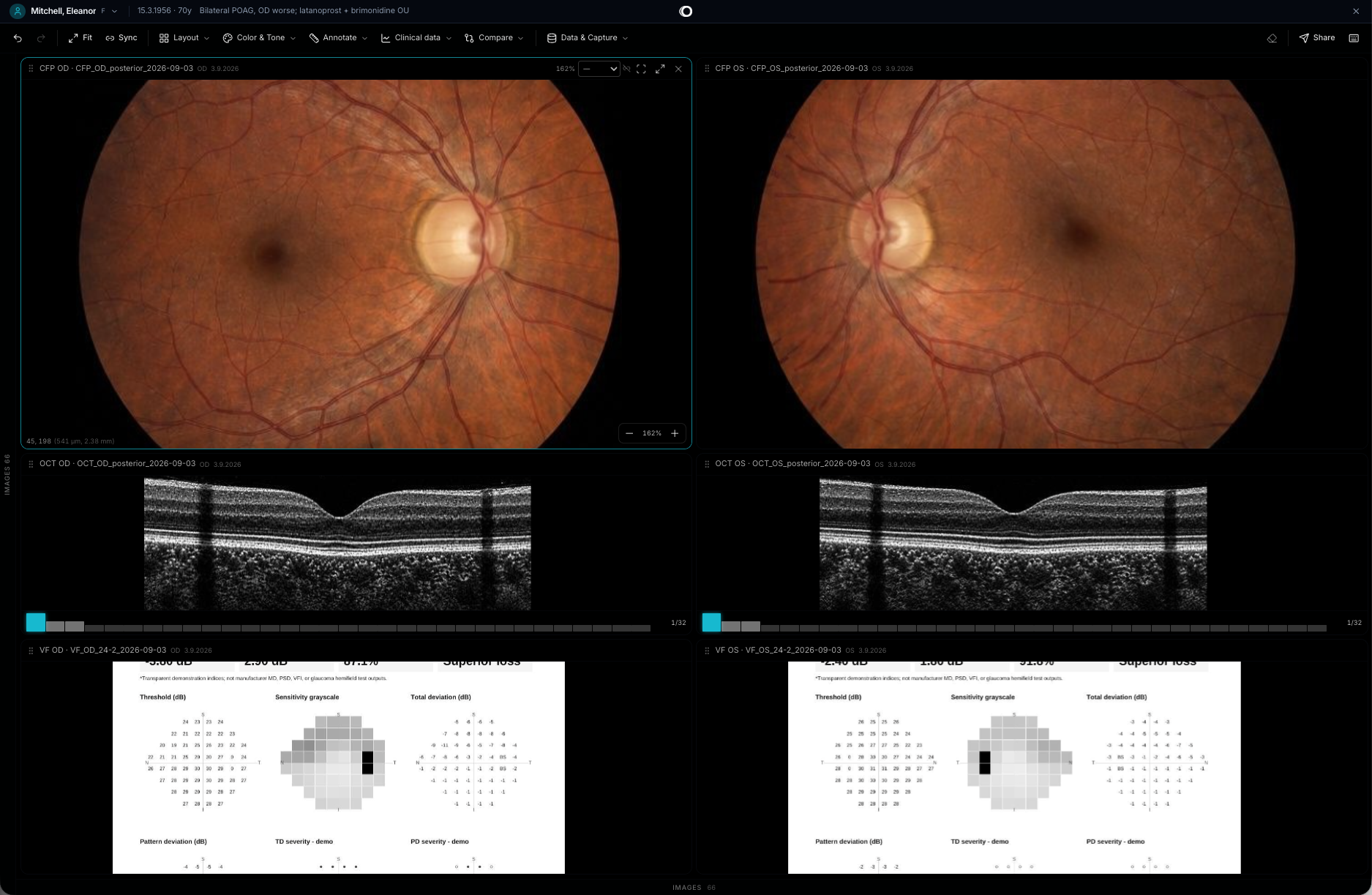 Eye images of the same patient side by side in the advanced viewer