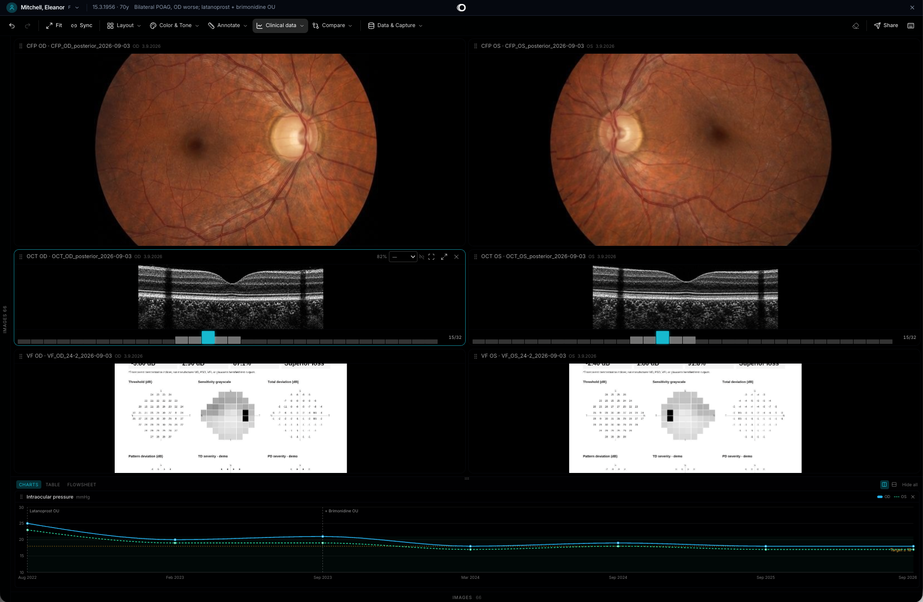 Ounas Loupe · Images and eye pressure